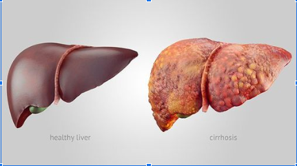 Latest Medical Advances in Cirrhosis Treatment and Liver Transplantation